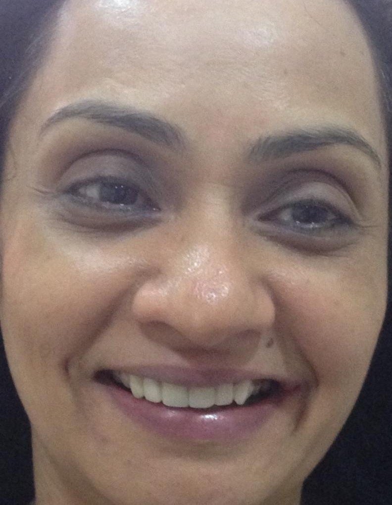 After smile makeover