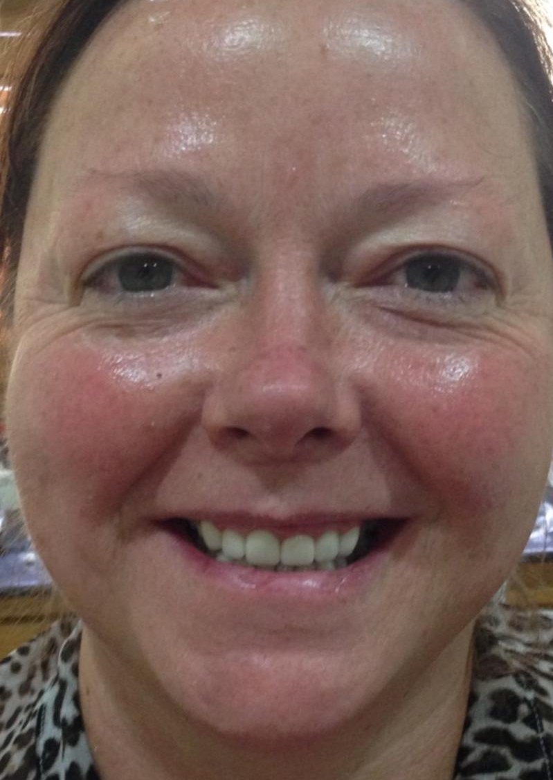 After smile makeover