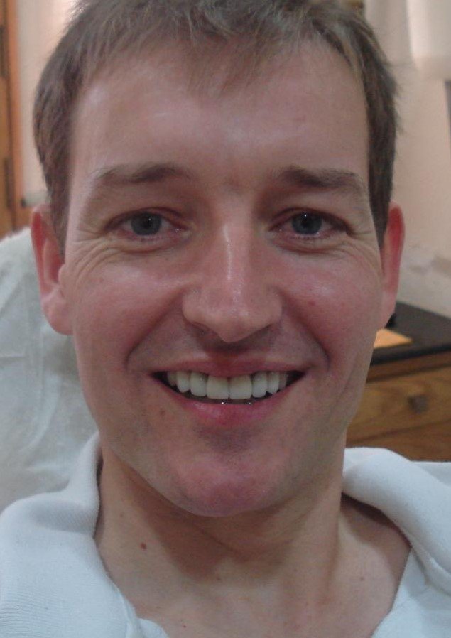 After smile makeover