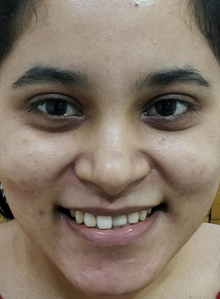 Before smile makeover