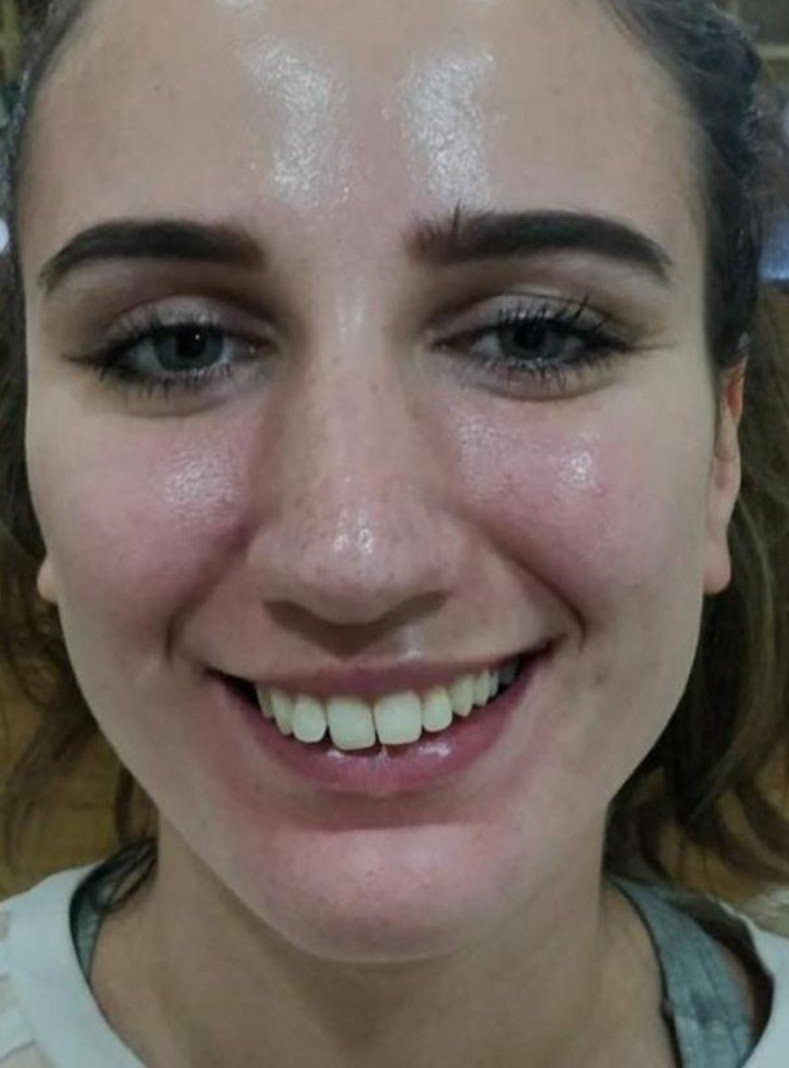 Before smile makeover