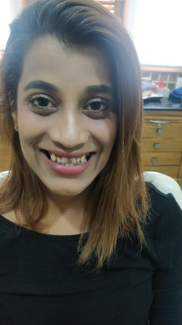 Before smile makeover