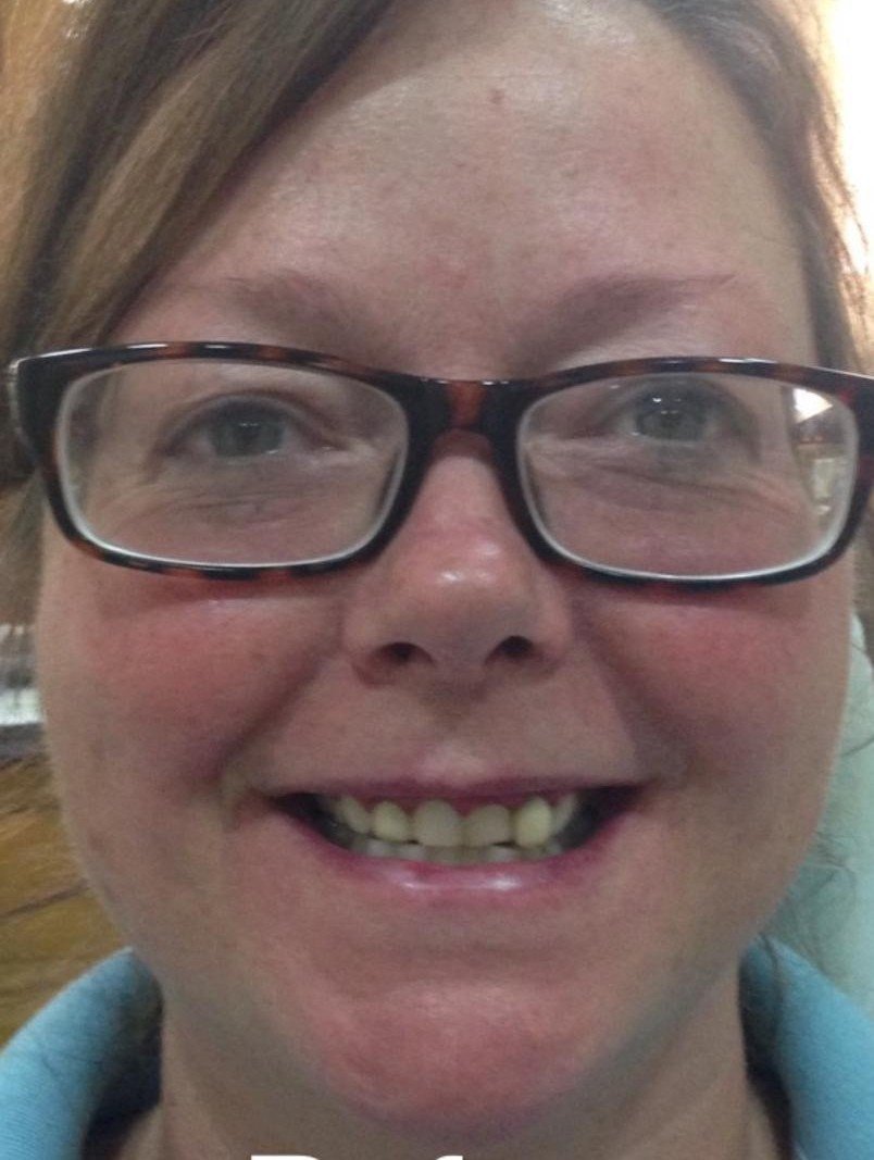 Before smile makeover