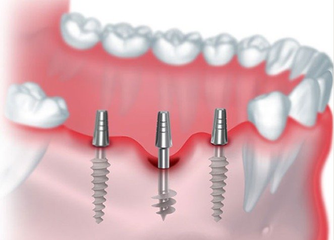 Single Stage Implants