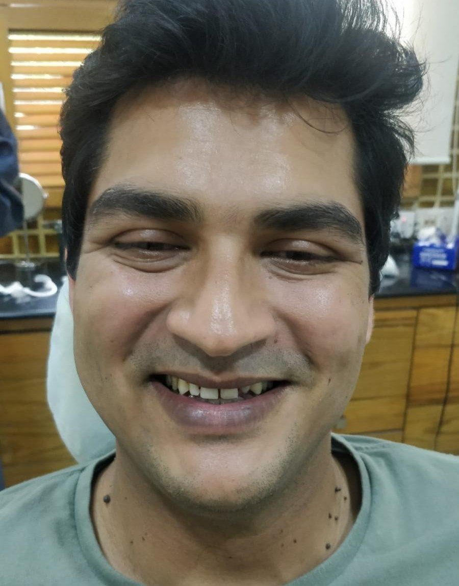 Before smile makeover