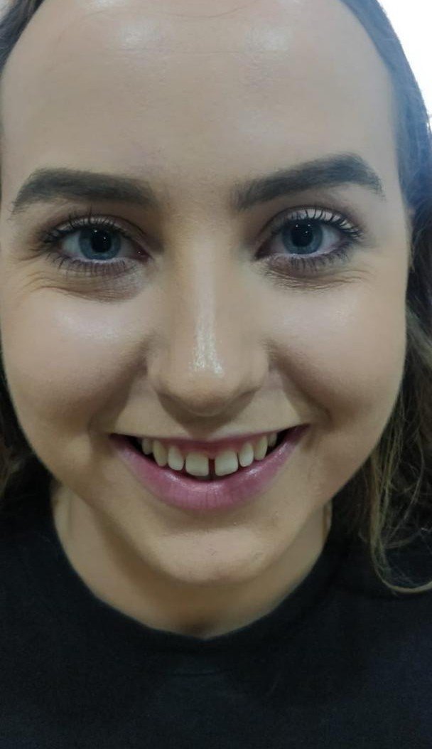 Before smile makeover