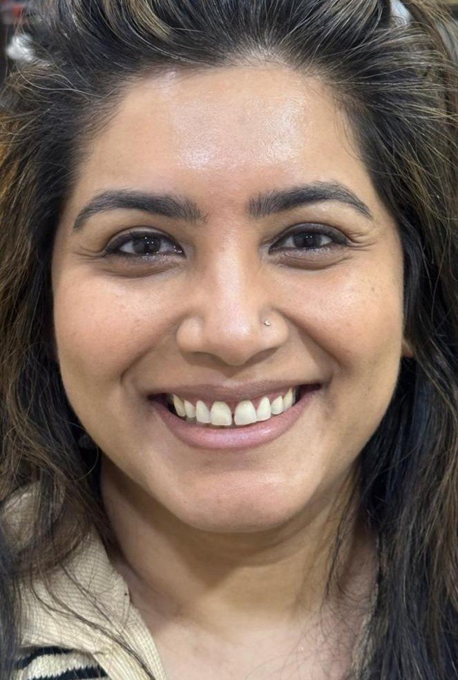 Before smile makeover